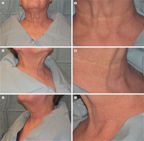 Objective And Subjective Scar Aesthetics In Minimal Access Vs