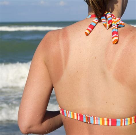 How Long Does A Sunburn Last—and Is There Any Way To Speed Up Healing