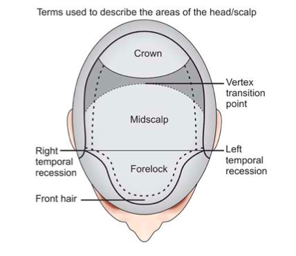 Frontal fibrosing alopecia refers to a receding hairline in women and is a form of scarring alopecia. Defining The Three Central Scalp Zones and Their ...