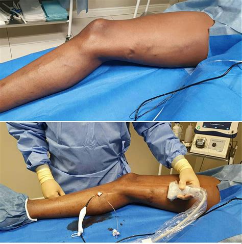 Your doctor may also ask you to describe any pain and aching in. Treatment of Varicose Veins in Nigeria (Vein Stripping Vs ...