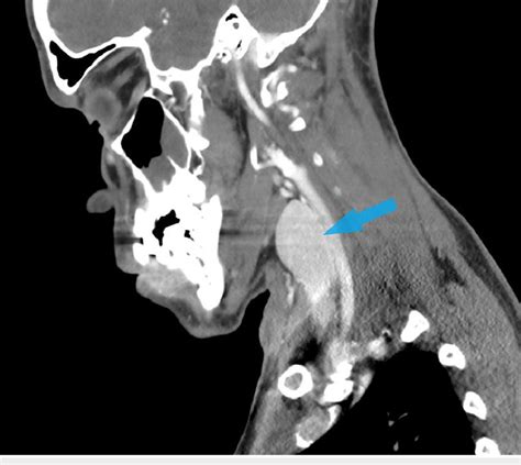 Ct Soft Tissue Neck With Iv Contrast Showing Hs Abscess In The Right
