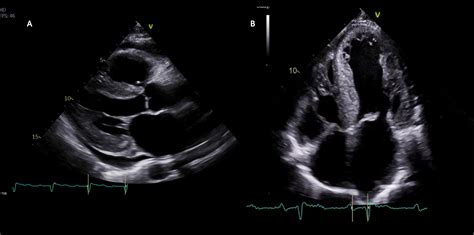 Practical Points For Echocardiography In Cardiac Amyloidosis Journal