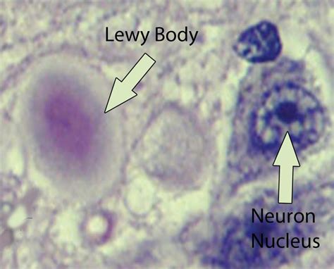 What Is Lewy Body Dementia Causes Symptoms Diagnosis Treatments
