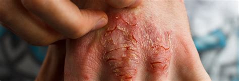 Eczema And Psoriasis Regenera Medical
