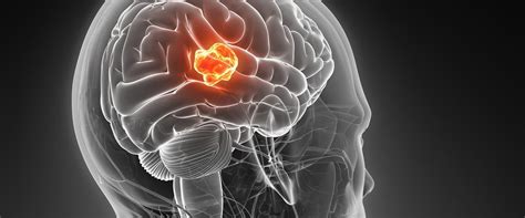 • we don't know the prognosis yet. Understanding Glioblastoma: The Most Common Type Of ...