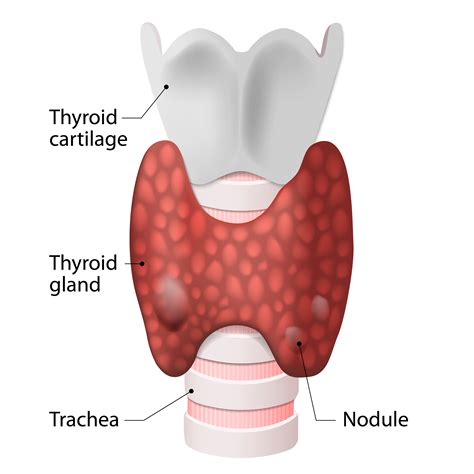 Symptoms Of Thyroid Nodule Youtube My XXX Hot Girl