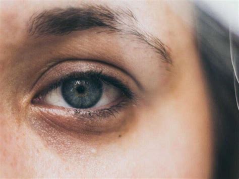 Puffy Eyes Meaning Symptoms Causes And Treatments