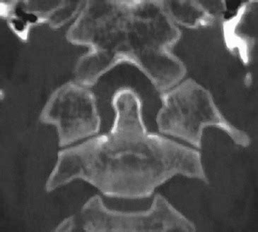 Atlas Fracture With An Intact Transverse Atlantal Ligament The Spine