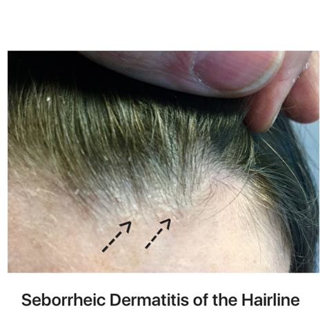 Can Drugs Cause Or Exacerbate Seborrheic Dermatitis — Donovan Hair Clinic