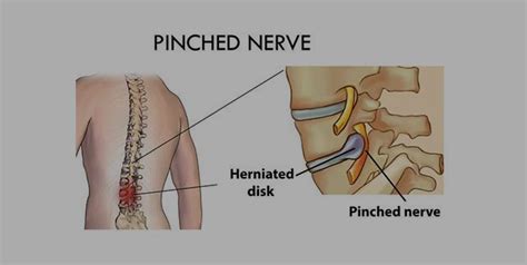 Pinched Nerve Causes And Remedies To Get Rid Of The Pain Onlymyhealth