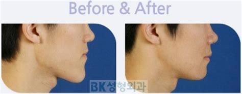 Bk Plastic Surgery Protruding Chin Correction