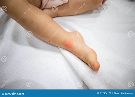 Closeup Insect Bites On Baby Leg With Allergy Spot Stock Photo Image