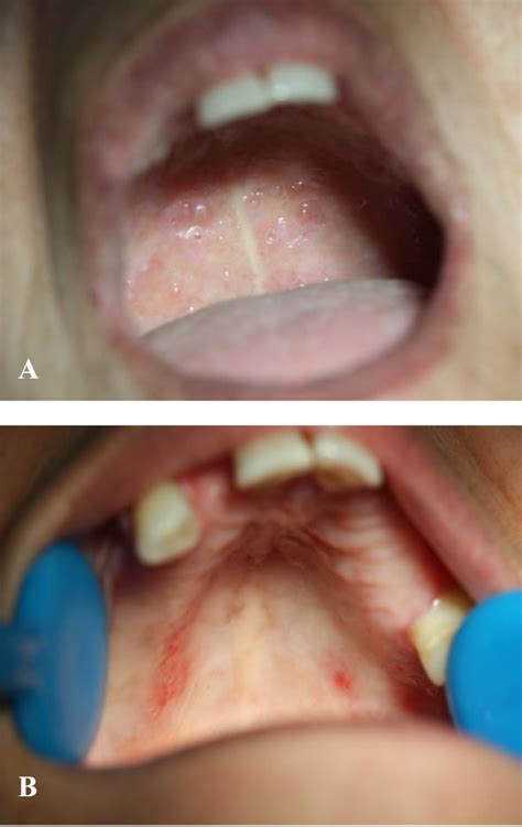 Multiple Recurrent Vesicles In Oral Mucosa Suggestive Of Superficial