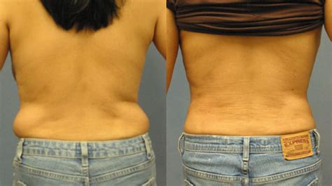 Liposuction Of The Love Handles In Los Angeles By Aaron Stone Md Can
