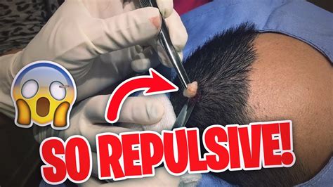 10 Of The Most Repulsive Moments On Dr Pimple Popper😝💦 Youtube