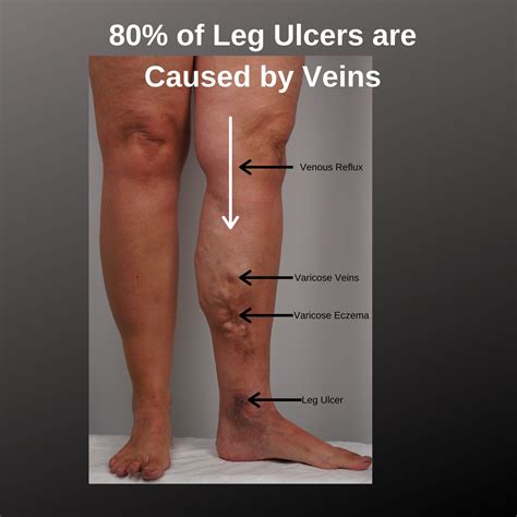 What Do Leg Ulcers Look Like The Veincare Centre