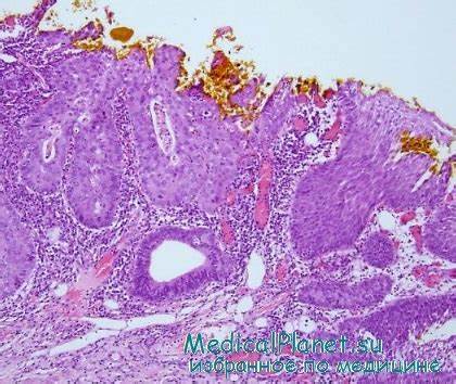 Диета рак шейки матки Микроинвазивный рак шейки матки (стадия Ia). Критерии Микроинвазивный рак шейки матки (стадия Ia). Критерии Диета рак шейки матки