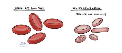 Iron Deficiency Anemia Mypathologyreportca