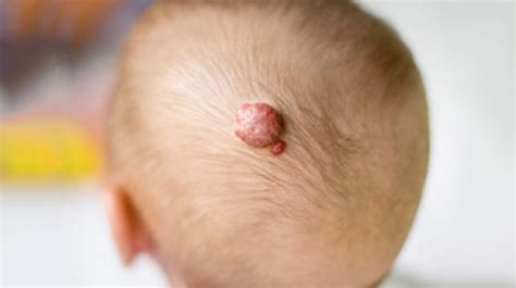Strawberry Hemangioma What They Look Like In Babies Causes And Effects