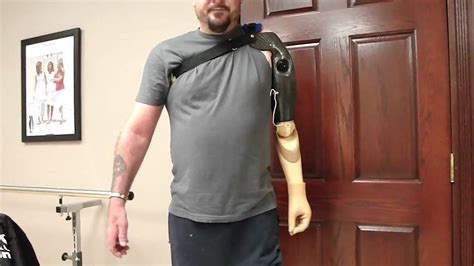 Above Elbow Prosthesis With Dynamicarm
