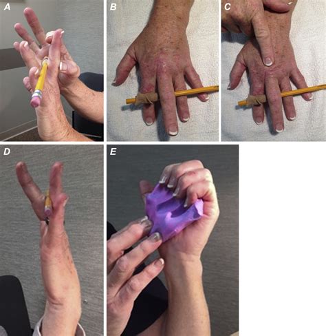 Two Case Reports—use Of Relative Motion Orthoses To Manage Extensor