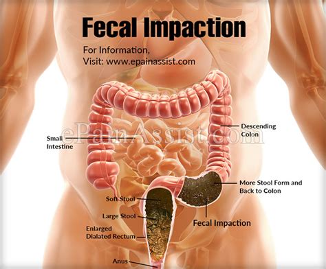 Operations in the abdomen create a potential for keep in mind, there are other health issues that could be causing this pain including hernias if you have a partial obstruction in which some food and fluid can still pass through, you may not need. What is Fecal Impaction & How is it Treated?
