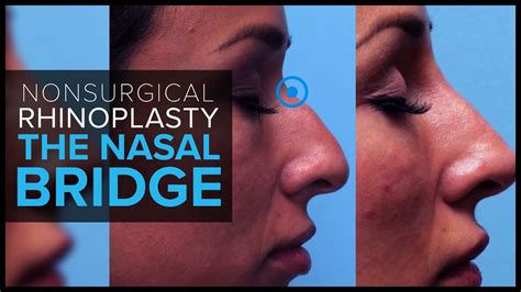 Non Surgical Rhinoplasty Contouring The Nasal Bridge With Dermal