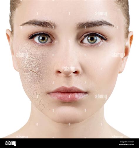 Young Woman With Dehydrated Skin Stock Photo Alamy