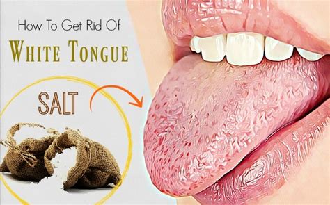 16 Natural Ways On How To Get Rid Of White Tongue Fast