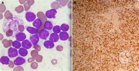 Diffuse Large B Cell Lymphoma In Leukemic Phase With Flower Cell Morphology
