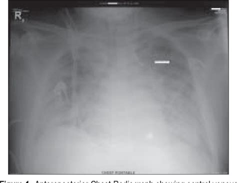 Figure From A Rare Malposition Of The Thoracic Venous Catheter