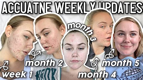 My Accutane Journey Weekly Updates Side Effects And Post Accutane