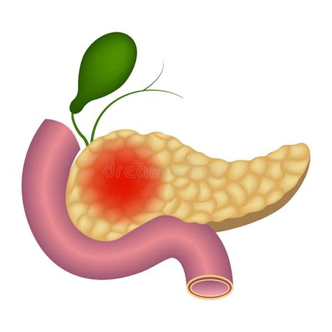 Inflammation Of The Human Pancreas Stock Vector Illustration Of
