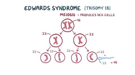 Edwards Syndrome Trisomy 18 Video And Anatomy Osmosis