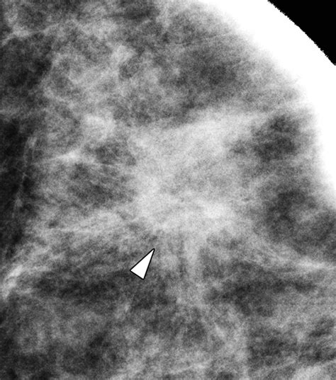 Invasive Lobular Carcinoma Of The Breast Spectrum Of Mammographic Us