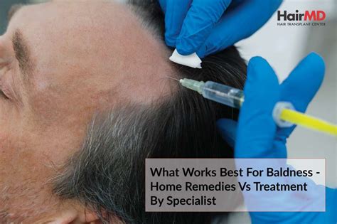 Best Baldness Reuslt Home Remedy Vs Treatment By Specialist