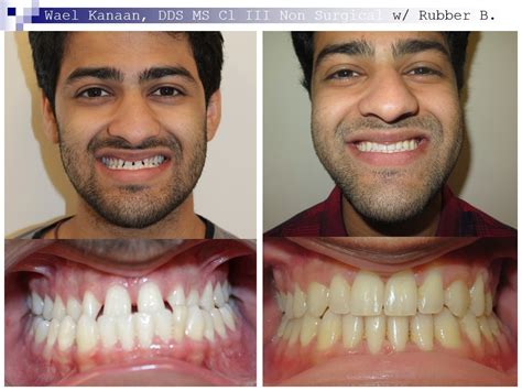 Underbite Correction Without Surgery In Sugar Land And Houston
