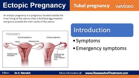Ectopic Pregnancy Tubal Pregnancy Introduction And Symptoms Youtube