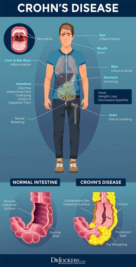 Disease Symptoms Artofit