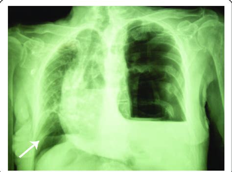 Initial Chest X Ray Showing A Left Tension Pneumothorax With Shift Of