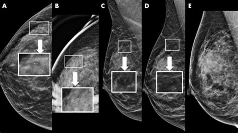 Multicenter Evaluation Of Breast Cancer Screening With Digital Breast