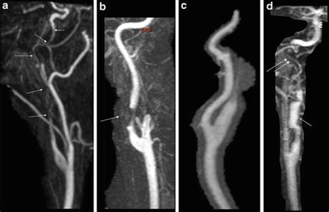 Carotid Artery Dissection Radiology Key