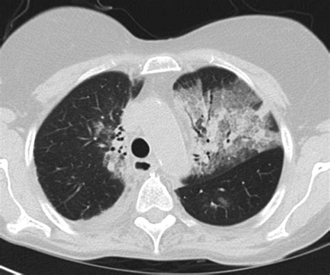A Case Of Exogenous Lipoid Pneumonia Respiratory Care