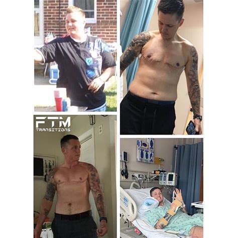 Phalloplasty Before And After Ftm