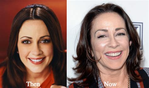Patricia Heaton Plastic Surgery Before And After Photos