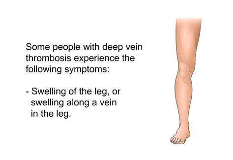 Preventing Deep Vein Thrombosis