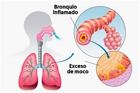 Qu Es La Bronquitis Principales Tipos S Ntomas Y C Mo Se Trata Tua
