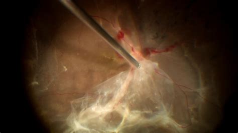 23 G Vitrectomy In Tractional Retinal Detachment Youtube