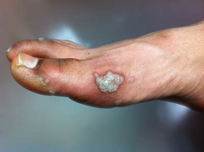 salicylic acid for wart - pictures, photos Plantar warts most commonly occur in children, adolescents and the elderly.