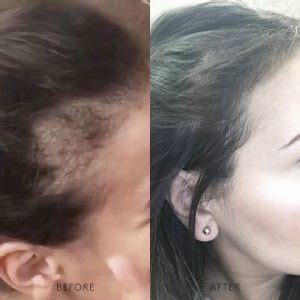What's the solution to sudden hair loss?.. - Yoko’s Haute Coiffure